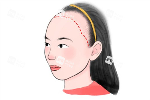 女型發(fā)際線種植卡通 女型發(fā)際線種植卡通