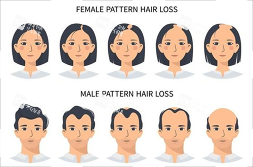 男女生發(fā)際線對比 男女生發(fā)際線對比