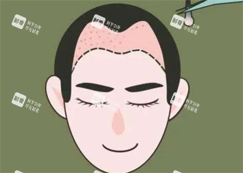 M型發(fā)際線種植 M型發(fā)際線種植