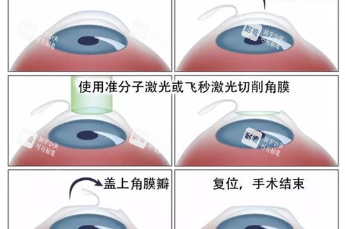 近視眼手術(shù)流程展示