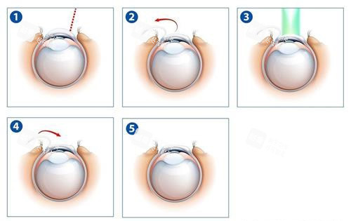 激光近視眼手術(shù)示意圖