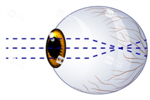 近視眼球示意圖