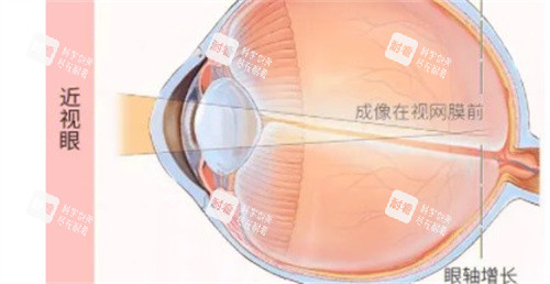 近視眼的成像