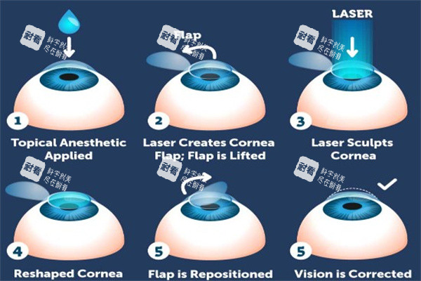 激光治療近視眼動(dòng)畫圖