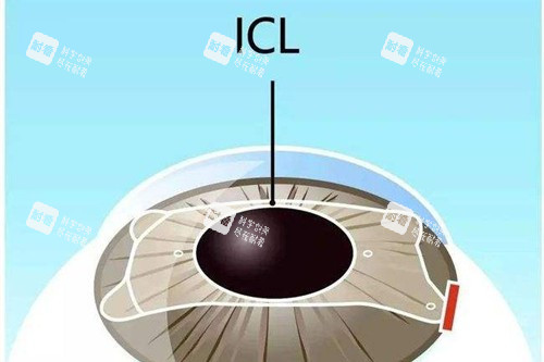 近視眼手術(shù)宣傳