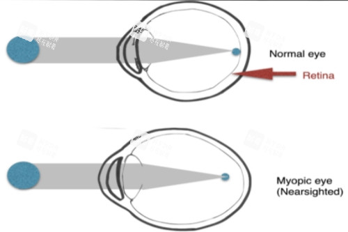正常眼與近視眼對(duì)比