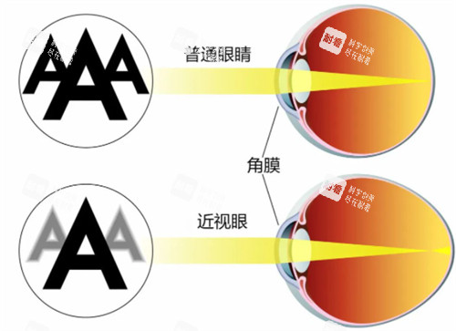 近視眼鏡與正常眼睛視物區(qū)別