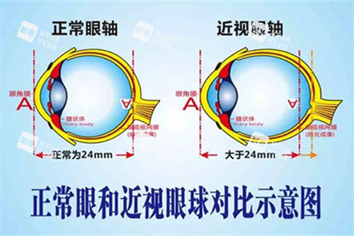 正常眼和近視眼球?qū)Ρ仁疽鈭D