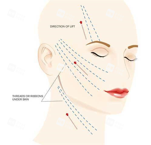 面部提升圖解析 面部提升圖解析