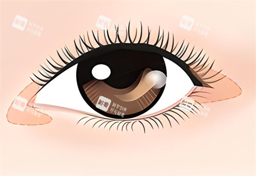 王振軍修復(fù)眼角靠譜的核心：V-Y推進術(shù)+內(nèi)眥贅皮重建技術(shù)詳解