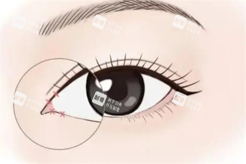 開眼角手術(shù)動(dòng)畫圖示