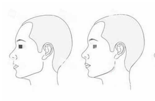 磨骨前后對(duì)比圖