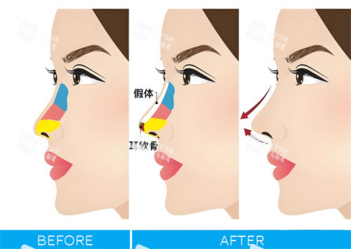 隆鼻手術(shù)圖解動(dòng)畫圖