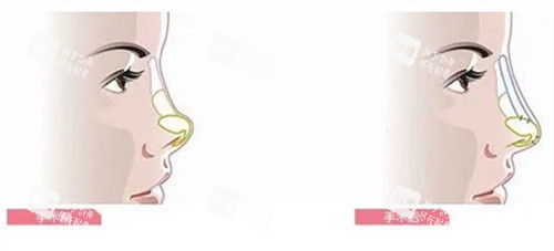 隆鼻手術(shù)前后對比