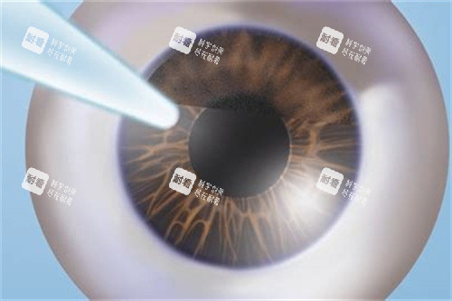 在鄭州近視眼矯正手術要多少錢？我找到了全術式價格表，快來看