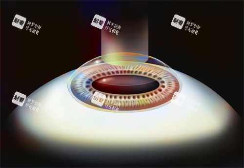 smart激光近視手術(shù)演示