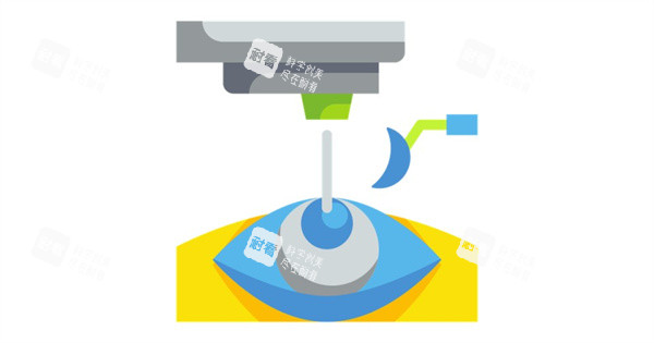 近視眼手術(shù)圖 近視眼手術(shù)圖