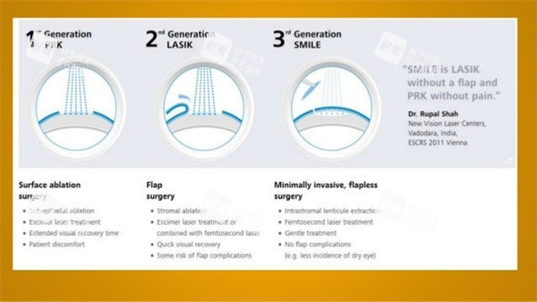 近視眼照片圖 近視眼照片圖