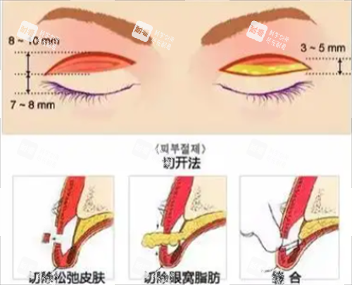 切開雙眼皮手術(shù)