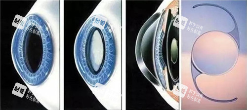 白內(nèi)障晶體手術(shù)細(xì)節(jié)圖