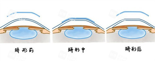 角膜塑形鏡矯正原理