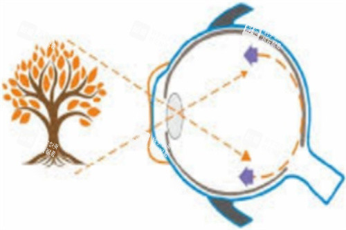 佩戴角膜塑形鏡視物