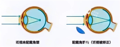 角膜塑形鏡前后 角膜塑形鏡前后