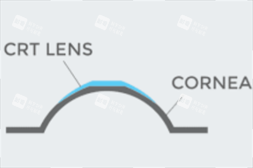 CRT角膜塑形鏡示意圖 CRT角膜塑形鏡示意圖
