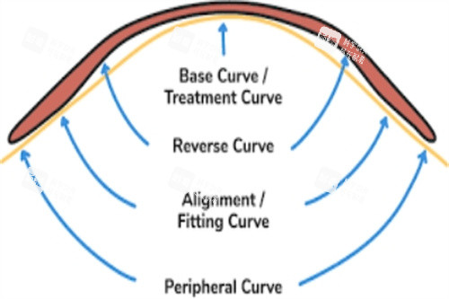 角膜塑形鏡作用示意圖 角膜塑形鏡作用示意圖