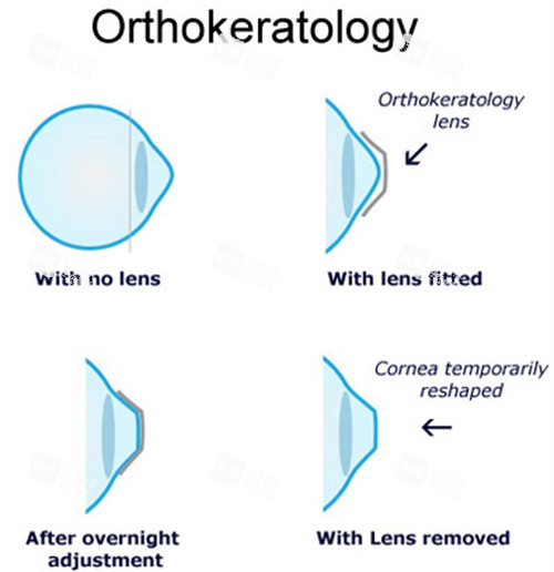 角膜塑形鏡佩戴前后對比 角膜塑形鏡佩戴前后對比