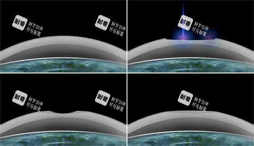 smart激光近視手術(shù)過(guò)程