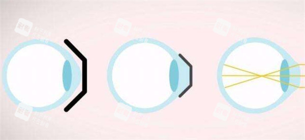 近視矯正過(guò)程中眼球的變化圖解