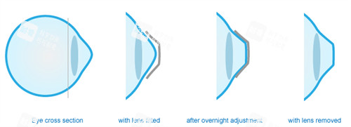 角膜塑形鏡可以改善眼表曲度 角膜塑形鏡可以改善眼表曲度