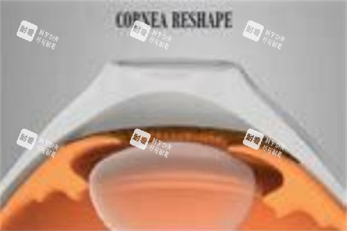 角膜塑形鏡3副本 角膜塑形鏡3副本