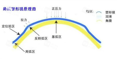 角膜塑形鏡原理示意圖