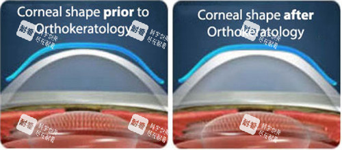 角膜塑形鏡眼表前后對(duì)比