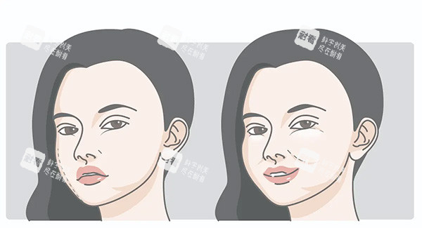 饅化臉對比照片