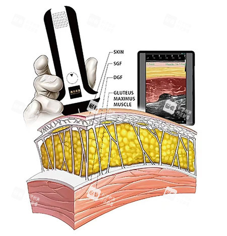 維密金雕原理示意圖