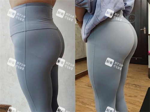 臀部吸脂手術(shù)側(cè)面對比圖