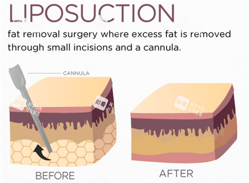 吸脂手術(shù)前后動(dòng)畫對(duì)比