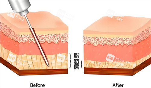 吸脂手術(shù)脂肪層對(duì)比