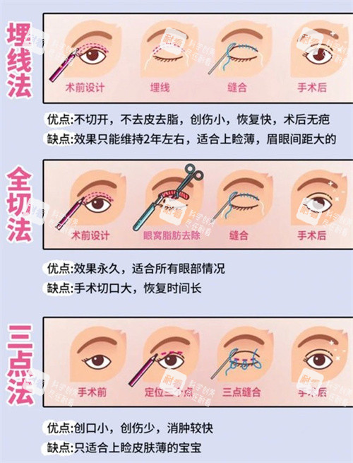 雙眼皮三種手術(shù)方式動(dòng)畫