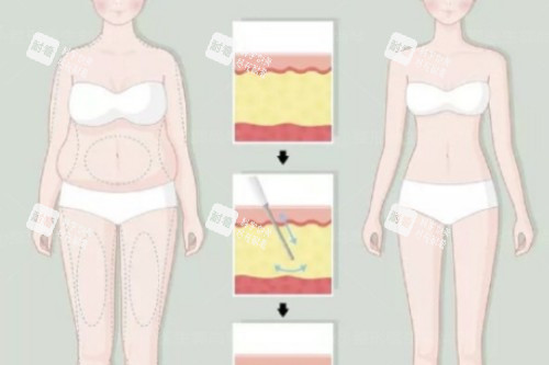 吸脂卡通前后對比圖