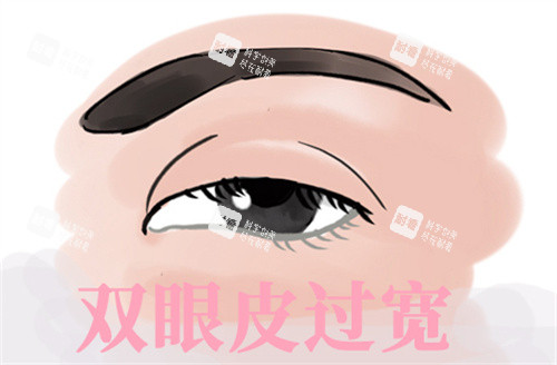 雙眼皮過寬修復(fù) 雙眼皮過寬修復(fù)