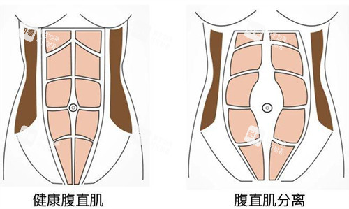 腹壁成形術(shù)前后腹直肌的變化圖解 腹壁成形術(shù)前后腹直肌的變化圖解
