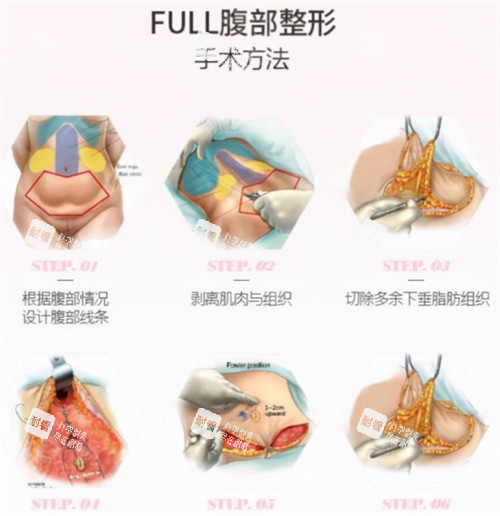 腹壁成形術(shù)手術(shù)過(guò)程圖解 腹壁成形術(shù)手術(shù)過(guò)程圖解