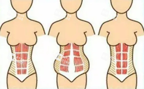 腹壁成形手術(shù)卡通示意圖 腹壁成形手術(shù)卡通示意圖