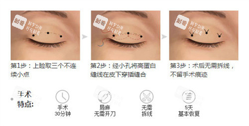 雙眼皮三點(diǎn)術(shù)過(guò)程特點(diǎn)