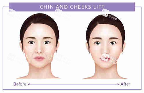 面部提升對(duì)比圖