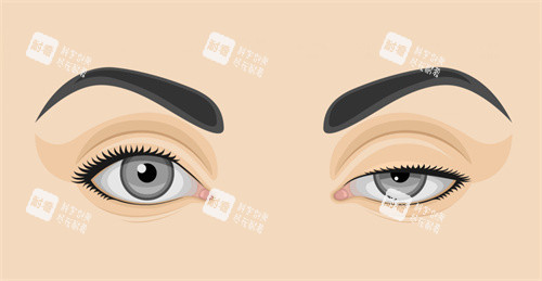 雙眼皮修復前后對比